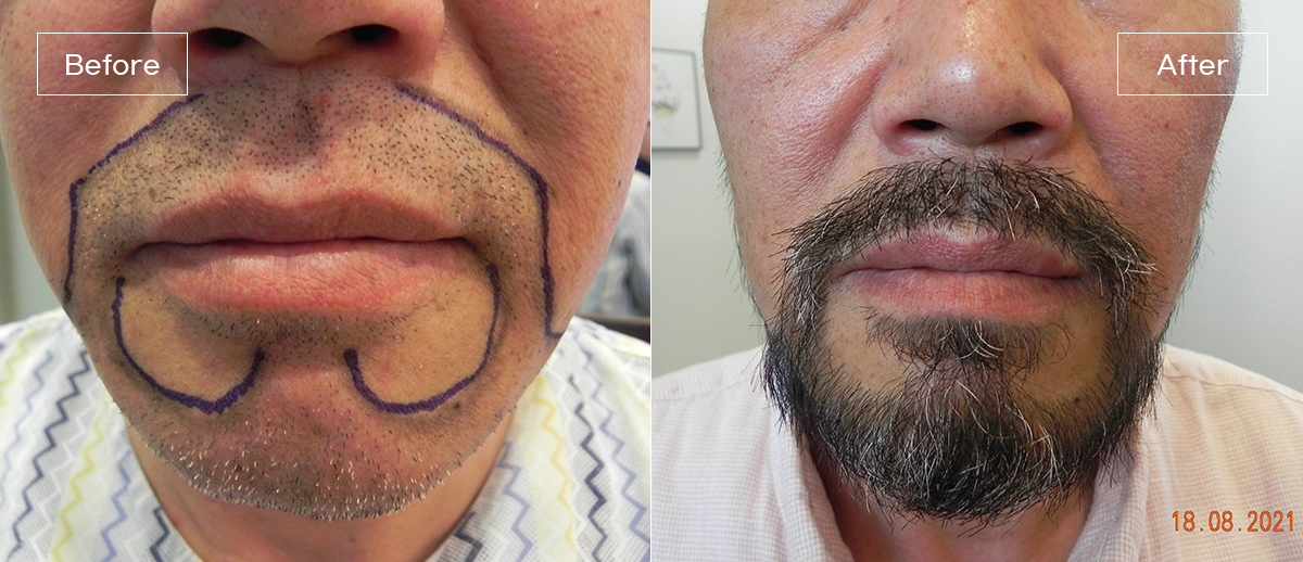 /filedata/md_board/20260205015002_mfIoAspG_4.jpg 전후사진